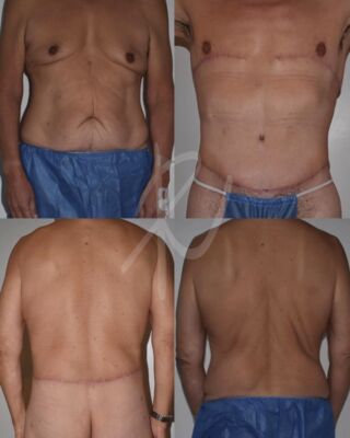 liposuction clinics tijuana Ricardo Vega