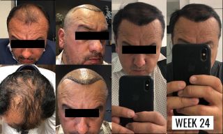 clinics hair transplant clinics tijuana TJ Hair Clinic