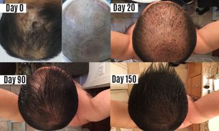 clinics hair transplant clinics tijuana TJ Hair Clinic